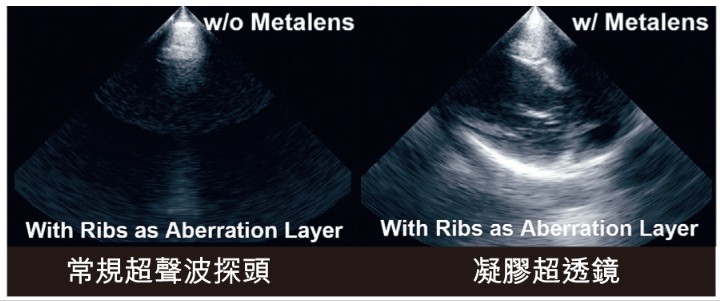 “SonoMeta” employs micro-structured materials to precisely control the path and phase of ultrasound waves, enabling effectively penetration of rib structures while significantly reducing reflection and scattering.